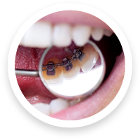 braces behind your teeth